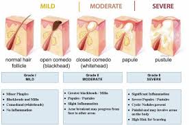 Program within @mayoclinicgradschool is currently accepting applications! How To Get Rid Of Acne Symptoms Causes Treatments And Prevention Health Life Media