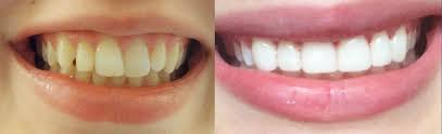 Pin On Benefit Teeth