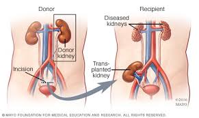 Donor Nephrectomy Mayo Clinic