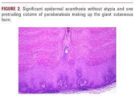 Image result for cornu cutaneum)