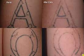 Tattoo removal in elgin, illinois. Tattoo Removal 10 1024x683 1 Skin Care Center Of Southern Illinois