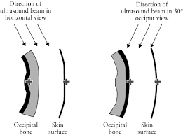 Measurement Of Nuchal Skin Fold Thickness In The Second