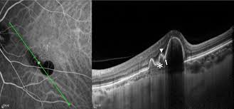 Polypoidal Choroidal Vasculopathy Ophthalmology