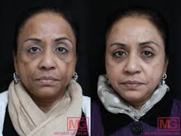 Looking for a chemical peel you can do at home? Chemical Peels Before After Photos Dr Michele Green M D