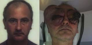 Hair loss. national cancer institute: Bilateral Orbital Lymphoma A Diagnostic Odyssey Through Surreal Clinical And Imaging Features Plus Therapeutic Implications Sciencedirect