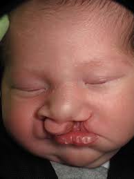 LOMA LINDA: Cleft lip, palate patients rejoice at reunion