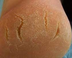 Heel Fissures Occur When The Skin On The Bottom Outer Edge Of The Heel Becomes Hard Dry And Flaky Sometimes How To Stay Healthy Skin Disorders Heel Fissures