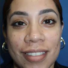 Come learn more about our new skin resurfacing laser (Ultra) at the 10 Yr  Anniversary & Open House next week!