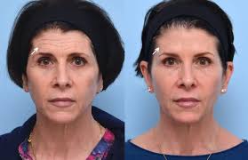 Botox Injection & Treatments In Dubai Abu Dhabi | Botox Dubai Offers  Reviews Best Aesthetic Clinic