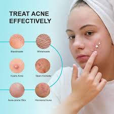 Image result for acne face
