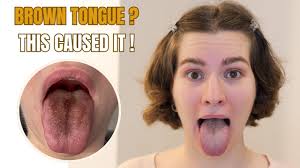 Image result for brown tongue symptoms