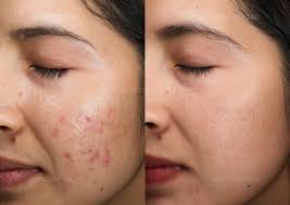 Image result for acne face