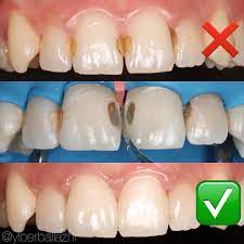 Some Lovely Front Teeth H White Fillings By Dr Ylberballazhi Great Work Doc Creating Beautiful Invisible White Dental Health Aesthetic Dentistry Dentistry