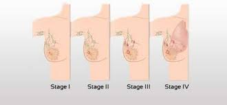 With other breast cancers, warning signs may not occur for years. Inflammatory Breast Cancer Symptoms Pictures Cancerwalls