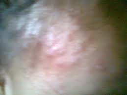 + anda tidak pandai bagi ubat tablet pada kucing (silap langkah boleh sampai tangan luka tercakar) + kucing anda bunting atau sedang menyusu. Ubat Kudis Buta Bernanah Perubatan M