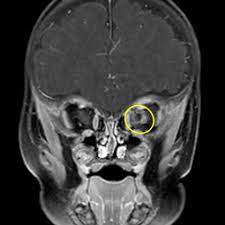 Morning Glory Disc Anomaly Eurorad