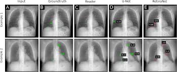Image result for lung cancer xray
