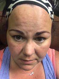 Charcoal mask results for rosacea-prone skin