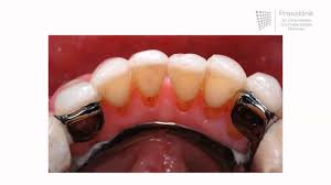 The best solution for fixing a broken tooth, veneer, denture, or restoration is to visit safe for oral use, it comes with polymer beads and instructions for replacing s single lost tooth, as well as a link that can take you to a video on how to use the product. Replacing Missing Teeth Different Dentures And How They Work Youtube