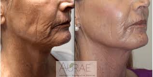 Before and after of patients right cheek. Morpheus8 What Is Morpheus8 Dr Emami Aurae Md Accutite