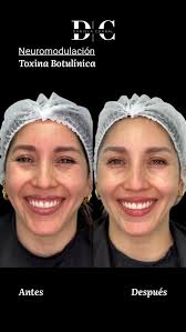 Botox💉❤️, Resultados máximos en 14 días con duración promedio de 4 meses  ✨, Más confianza, seguridad y bienestar físico y mental🤩, Agenda tu  evaluación en dracorral.cl👩‍💻, Nos vemos en la consulta! ...