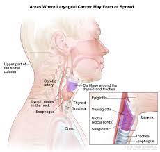 How do health care professionals determine throat cancer staging? Laryngeal Cancer Treatment Adult Pdq Patient Version National Cancer Institute