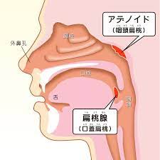 アデノイド顔貌をご存じですか アデノイド顔貌とはあごがほとんどなく いつも口がぽかんと開いているような独特の顔つきのことです 現代の日本人に増えてきたこの症状に悩んでる人は実は多いんです そんなアデノイド顔貌の秘密に迫ります アデノイド ゴボ 医療