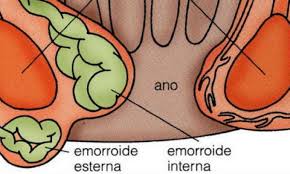 Emorroidi Interne Ed Esterne Cause Sintomi E Cure Greenme