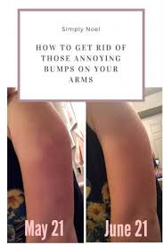 If the bumps are still not improved in four weeks, consider adding a retinol like essopi 5x retinol smoothing serum every night. How To Get Rid Of Keratosis Pilaris Simply Noel Blog