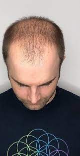 When hair starts falling, men start becoming desperate. Mens Hair 2 Go Hair Systems Uk Mens Hair Replacement Hair Systems London