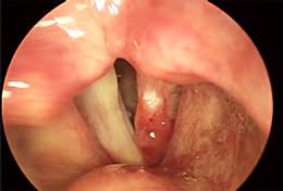 For example, only a few people who have ever smoked cigarettes get lung regular smears in women detect precancerous changes in the cervix at an early stage when treatment is simple and effective. Early Signs Of Throat Cancer Pictures Celine Dion Songs Age