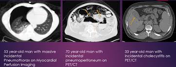 Image result for Incidental Imaging Finding