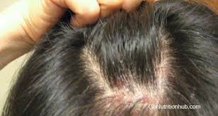 Pimple Like Bumps On Scalp Go Nutrition Hub Pimples On Scalp Sores On Scalp Scalp Acne