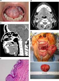 A google ingyenes szolgáltatása azonnal lefordítja a szavakat, kifejezéseket és weboldalakat a magyar és több mint 100 további nyelv kombinációjában. Floor Of Mouth Dermoid Cysts Report Of 3 Variants And A Suggested Change In Terminology Journal Of Oral And Maxillofacial Surgery