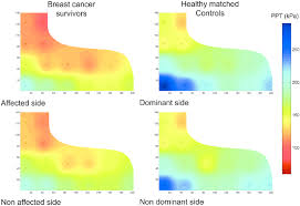 I've treated two patients in the last few months whose lung cancer presented with shoulder pain. The Pressure Pain Threshold Ppt Maps From The Dorsal Part Of The Download Scientific Diagram