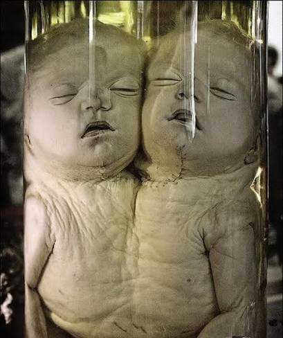 UN BEBE QUE PUEDE NACER UNIDO A OTRO Los bebés que nacen unidos por alguna  parte del cuerpo, conocidos como gemelos siameses, son un fenómeno raro y  fascinante de la naturaleza. Ocurren