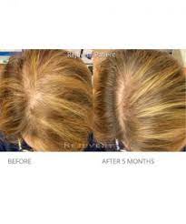 The hair loss did not start until 2 months after my course was over. Nutrafol Hair Growth Supplements Rejuvent Skincare