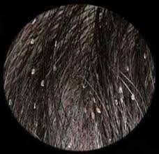 Treating Head Lice In Afro Hair Head Louse Afro Hairstyles Louse