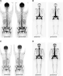 Puted tomography (ct) scan, able to detect lesions as. At Initial Diagnosis Of Recurrent Breast Cancer 18 F Fdg Pet Ct And Download Scientific Diagram