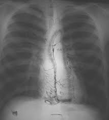 The hepatic flexure and the. Normal Chest X Ray Litfl Medical Blog Labelled Radiology