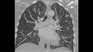 Computertomographie Des Thoraxbereiches Lunge Ct Mrt Institut Berlin