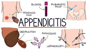 Image result for Appendicitis