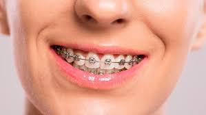 Check spelling or type a new query. What About Coverage For Braces Get A Free Health Insurance Quote