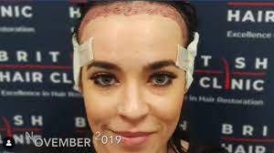 An artist comfortable performing either jazz standards or tales of the cowboy life, singer/songwriter stephanie davis was born and raised in montana to a family involved in cattle ranching. Stephanie Davis Thrilled With Results Of Hair Transplant