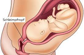 Bei manchen frauen löst sich der schleimpfropfen aber erst mit aufkommen der ersten wehen. Wenn Der Schleimpfropf Sich Lost Aussehen Funktion Und Abgang Wiado De