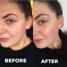 How To Get Rid Of Peach Fuzz On Face Dat Glow Tho Dermaplaningfacial Before And After Dermaplaning Is An Exfoliation Method That Uses A Sterile Surgical Blade To Remove Dry Skin And Peach Fuzz Fr Chemical Peel Anti Aging Skin