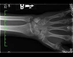Check spelling or type a new query. What A Broken Wrist Taught Me About Drawing Skills Vitruvian Fine Art Studio