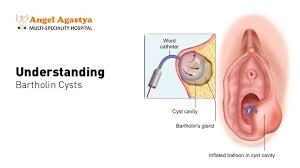 Image result for Bartholin's gland abscess