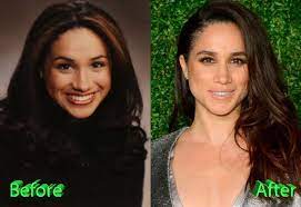 When meghan markle was just starting out in hollywood, she earned extra money by doing calligraphy. Meghan Markle Before And After Rhinoplasty Surgery Celebrity Plastic Surgery Rhinoplasty Surgery Meghan Markle Nose Job