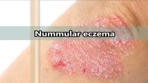 We did not find results for: Nummular Eczema What Is Nummular Eczema Youtube